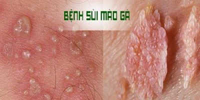 phuong-phap-dot-sui-mao-ga-bang-dien-cao-tan