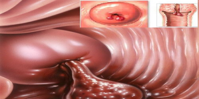 polyp-co-tu-cung-nguyen-nhan-trieu-chung-cach-chua