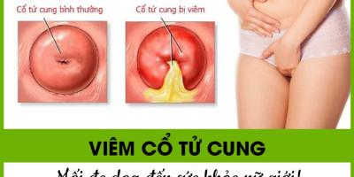 viem-tu-cung-viem-co-tu-cung-nhung-dieu-can-biet